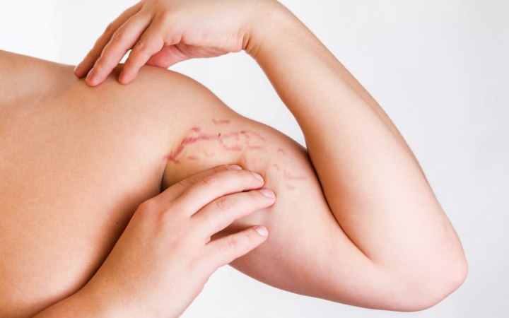 Upper arm with stretch marks