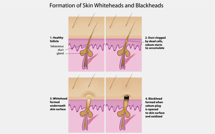 The formation of skin blackheads and whiteheads