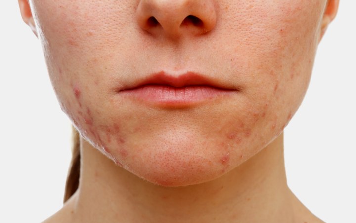 Face with acne