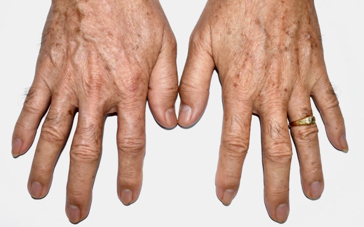 Hands with aging spots