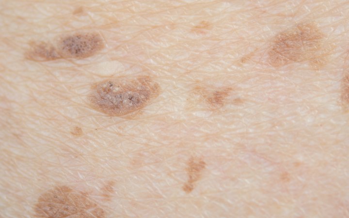 Skin with dark pigmentation